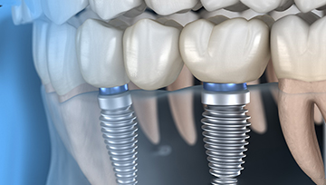 Diagram highlighting a dental bridge in Ann Arbor