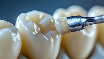 Dental sealants being applied to teeth