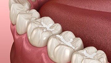 Digital image of tooth-colored fillings