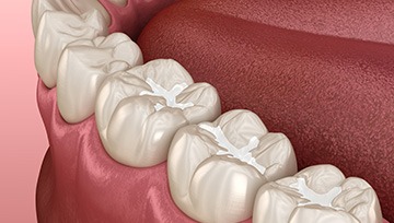 Closeup of smile with natural fillings