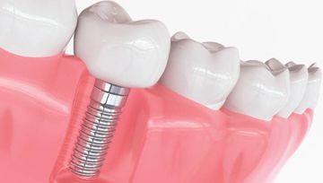 dental implant