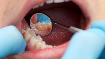 Closeup of teeth during gum disease screening