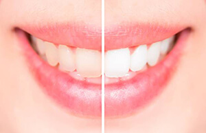 teeth whitening