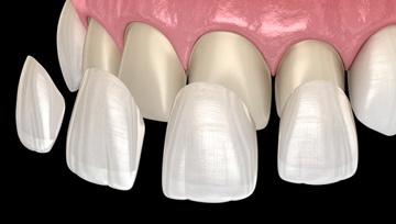 veneers being placed over the upper front teeth