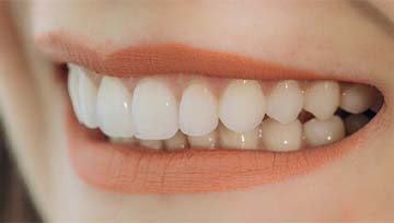 Closeup of woman smiling with veneers in Ann Arbor