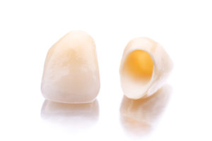 Two dental crowns prior to restoration