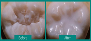 before and after photo of a tooth with and without a dental sealant